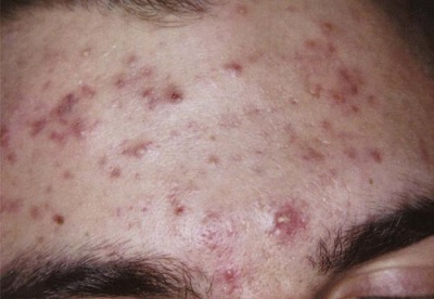 acne-rosacea-fig1_large